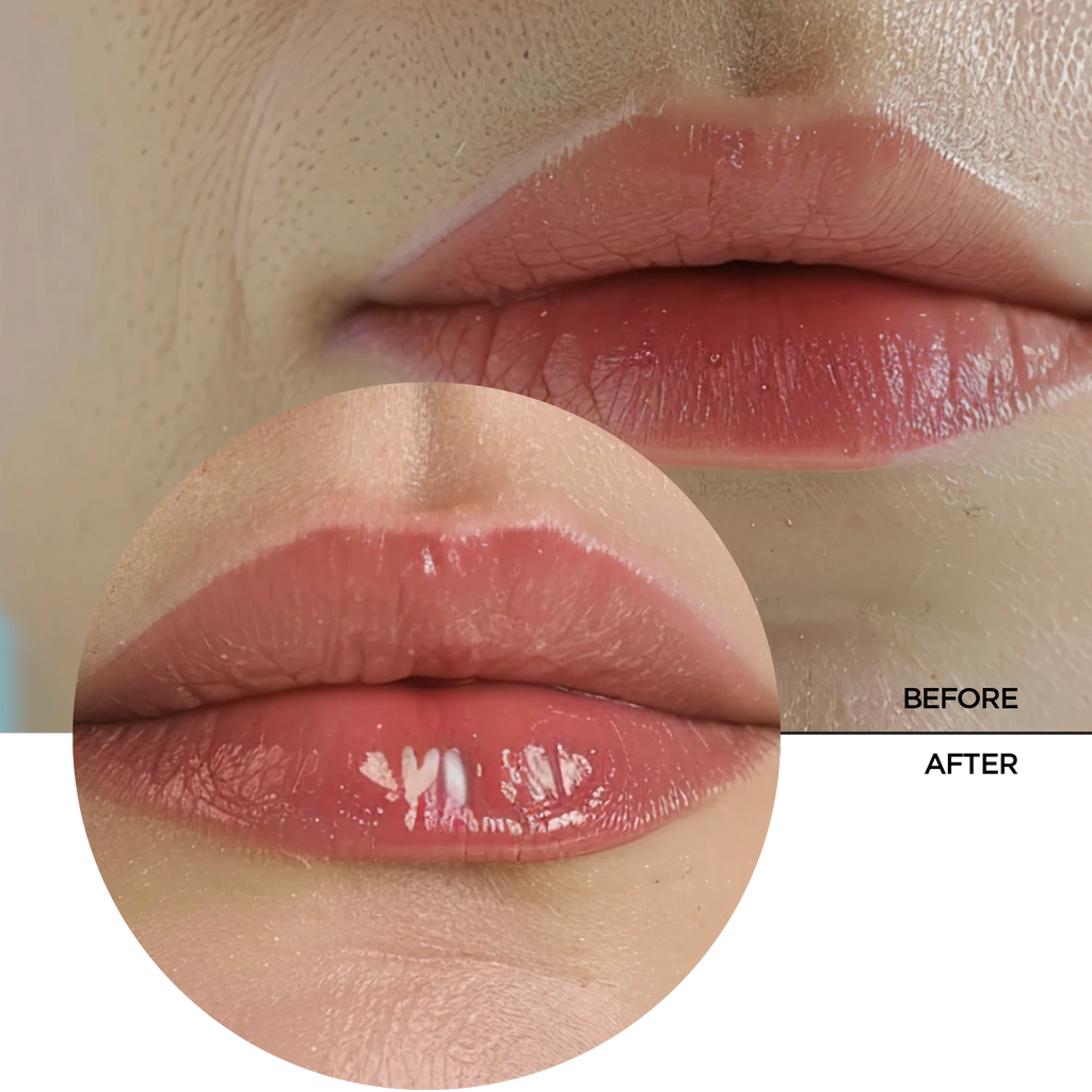 LIP FILLER HYALURONIC ACID Revox B77 LIP FILLER HYALURONIC ACID Revox B77