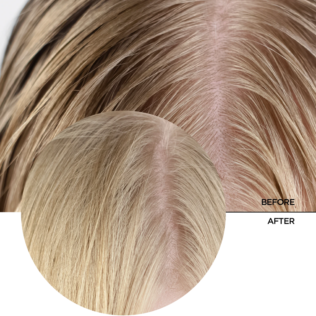Acide Salicylique 2 % pour le Cuir Chevelu